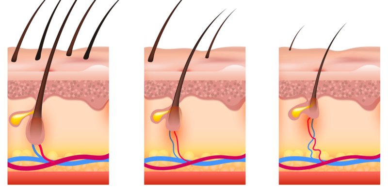 Sudden Hair Loss In Men