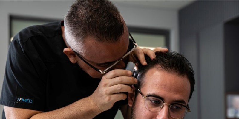 Second Hair Transplant