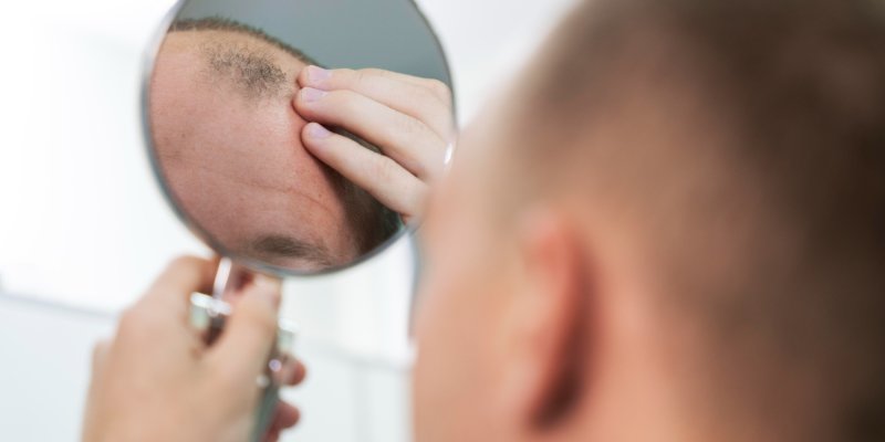 Lupus Hair Loss