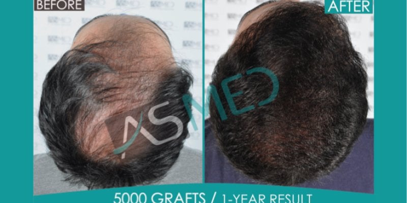 Hair Transplant in Turkey Before and After