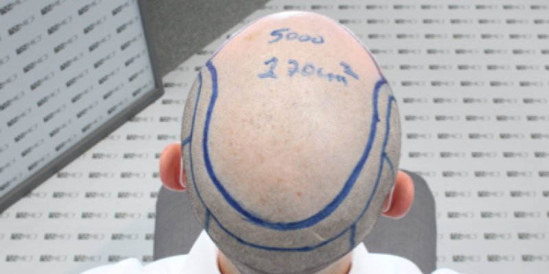 Full Head Hair Transplant
