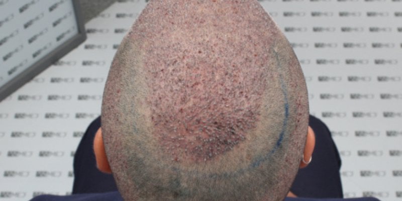 График трансплантации  волос на макушке
