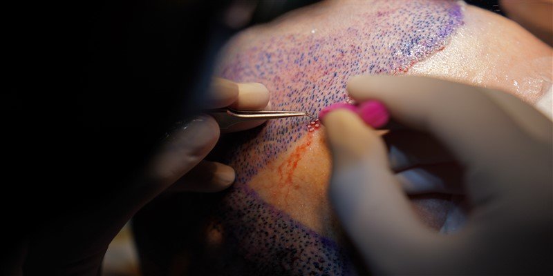 What to Do for Pimples After Hair Transplant