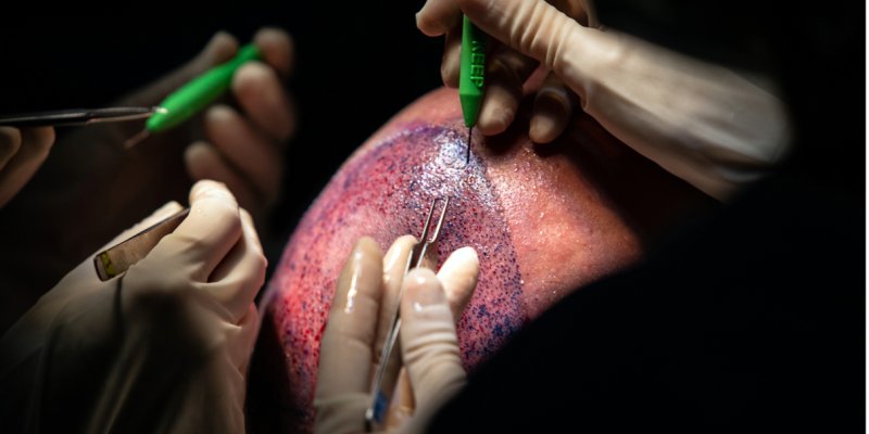 Turkey for Hair Transplant