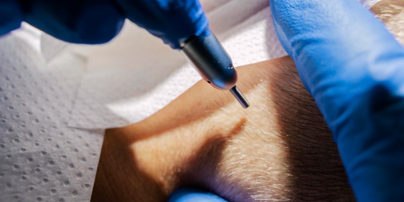 Hair Thinning After Hair Transplant