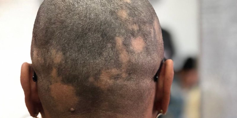 Pérdida irregular de cabello