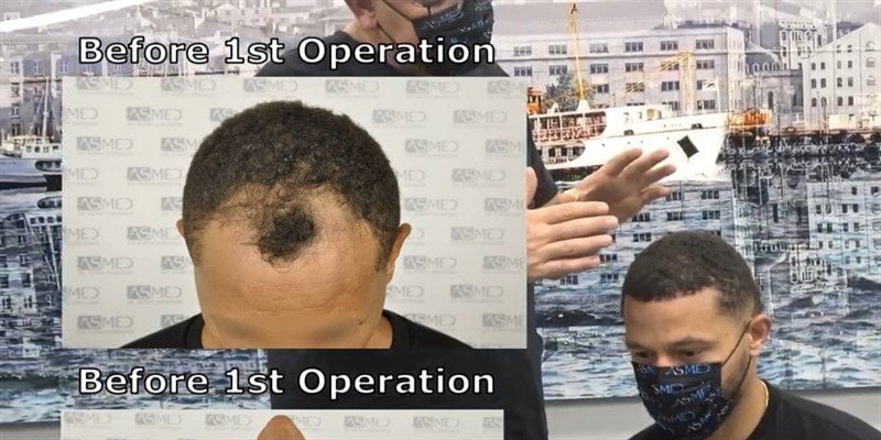 Schwarze männliche Haartransplantation