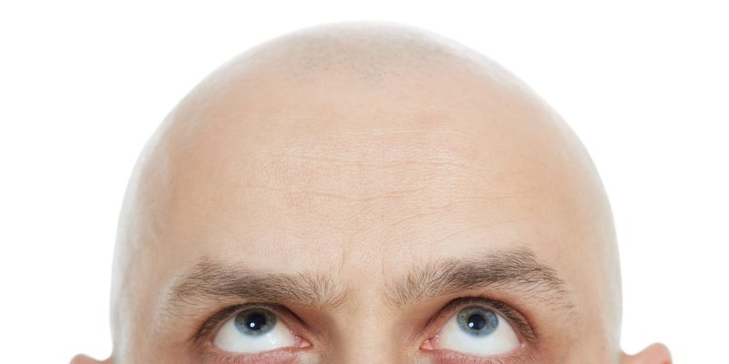 Excessive Hair Loss