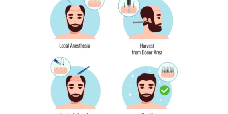 Hair Transplant Growth Stages