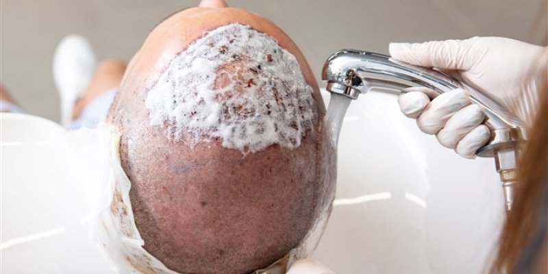 Shampooing After Hair Transplant