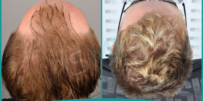 Hair Transplant After 10 Years