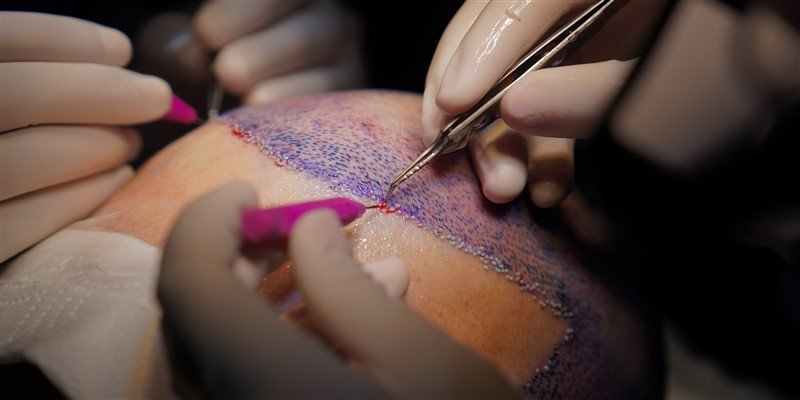 Difference Between DHI and FUE