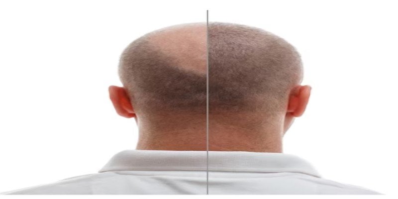20 Days After Hair Transplant