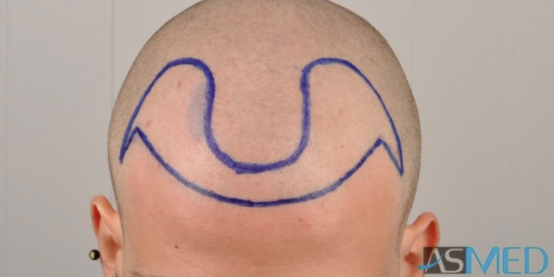 How Much Areas Do 2000 Grafts Cover