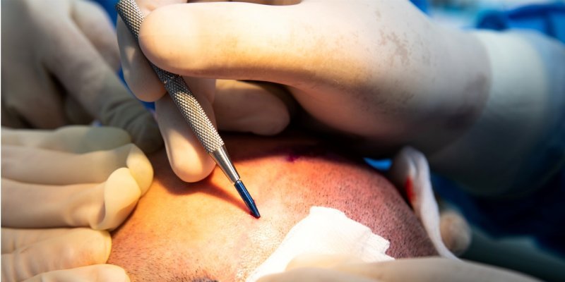 How Painful Is A Hair Transplant?