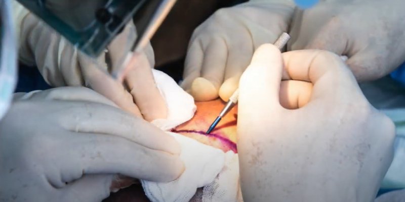 How To Get A Hair Transplant In Turkey