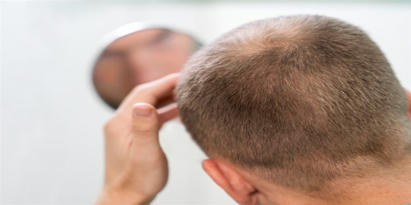 Why is My Hair Part Widening?