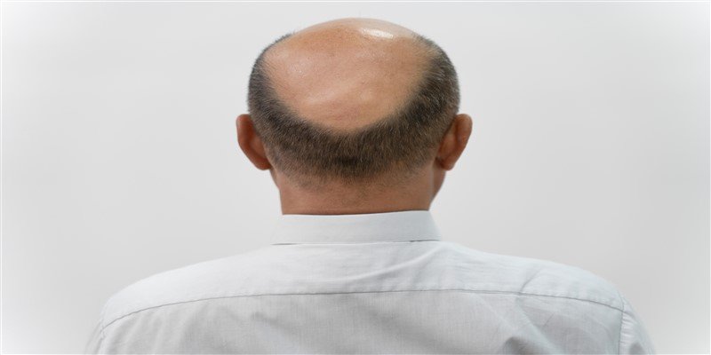 Telogen Effluvium: Definition, Causes, Symptoms & Treatment