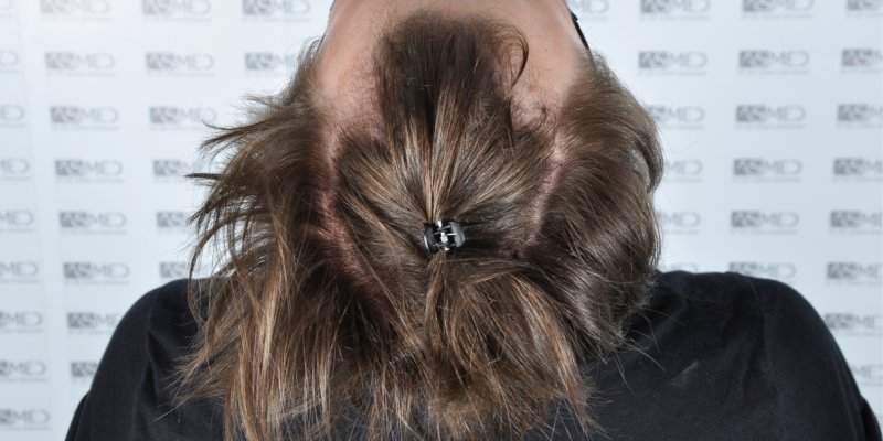 Thinning Hairline