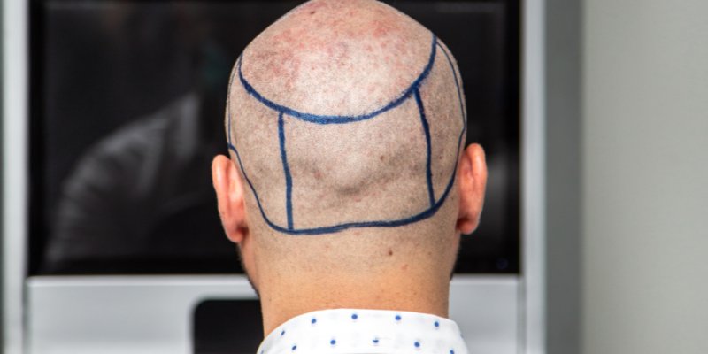 Hair Transplant Donor Area Recovery