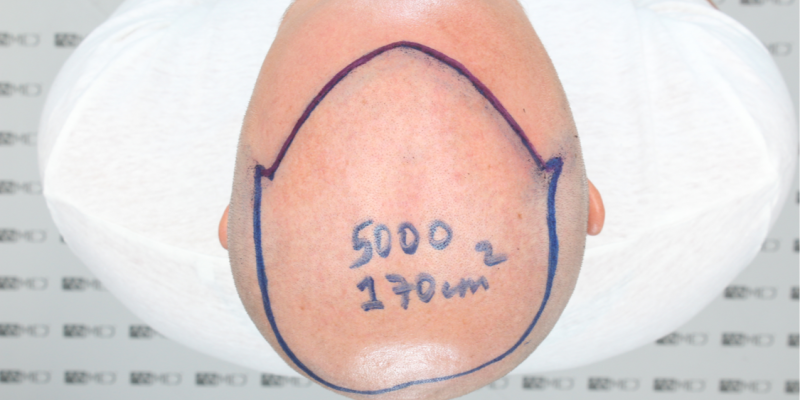 5000 Grafts Hair Transplant Cost Turkey