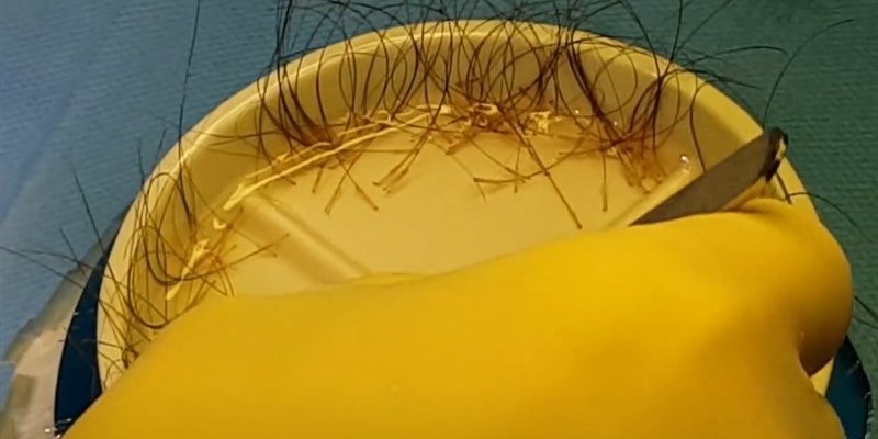 Hair Transplant Without Shaving Head