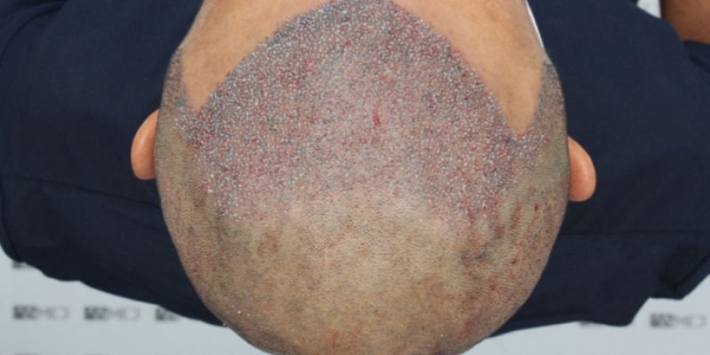 How Much Do 3000 Grafts Cost in Turkey