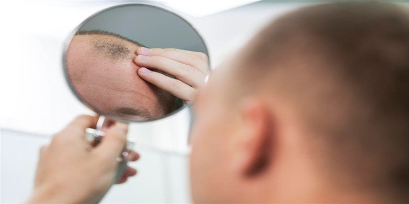 What is an M-shaped hairline?