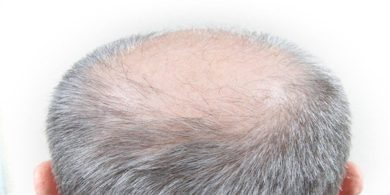 Bald Spot on Crown