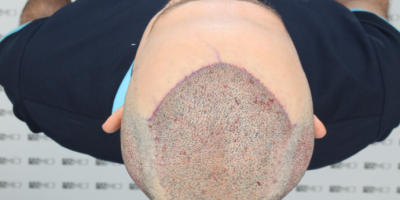 First Hair Transplant