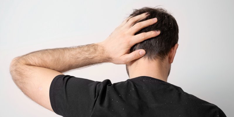 Redness After Hair Transplant: Causes, Symptoms, and Duration