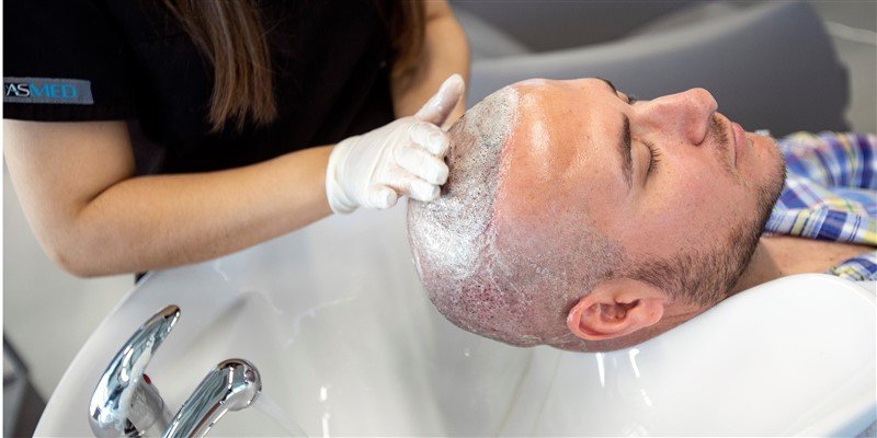 Swelling After Hair Transplant