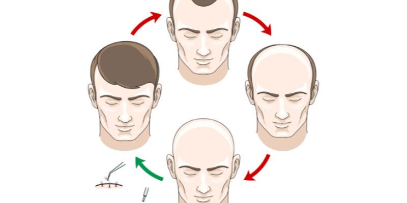 What Causes Male Pattern Baldness