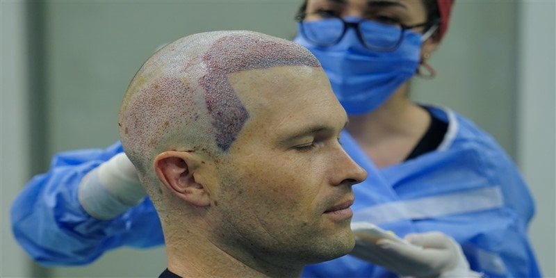 Is Hair Transplant Natural?