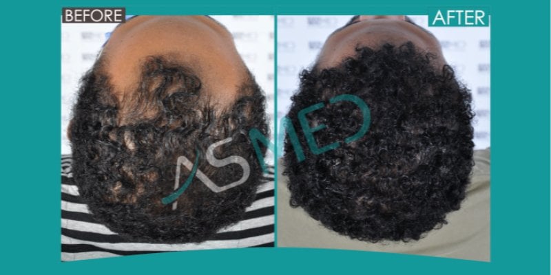African American Hair Transplant Before After - Asmed Hair Transplant