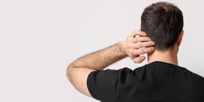 Itching After Hair Transplant