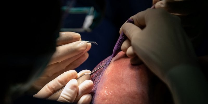 African American Hair Transplant in Turkey - Cost & Procedure