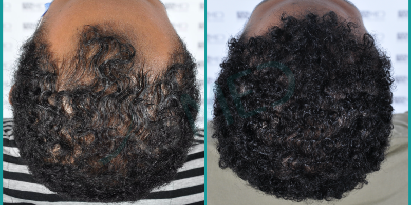 Afro Hair Transplant Istanbul
