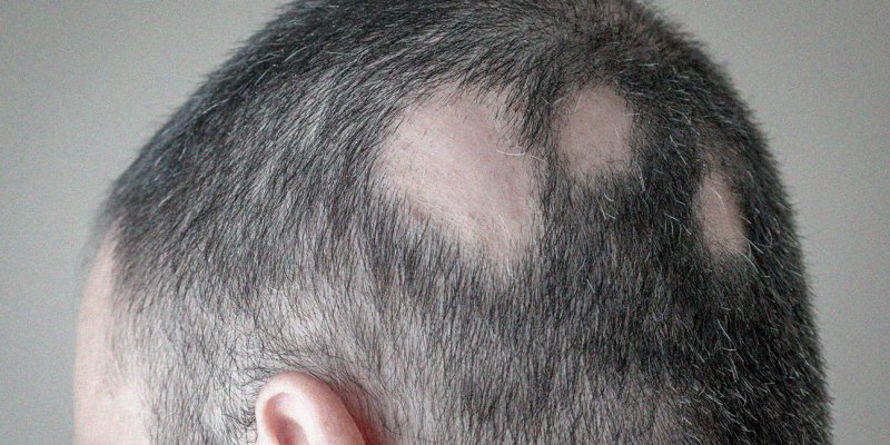 Fungal Hair Loss