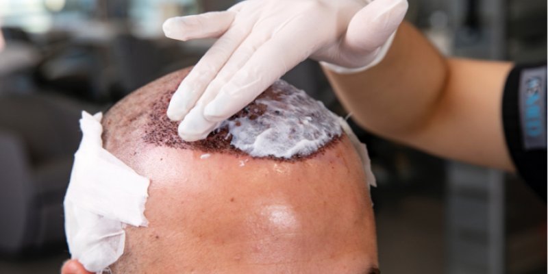 Hair Transplant Aftercare