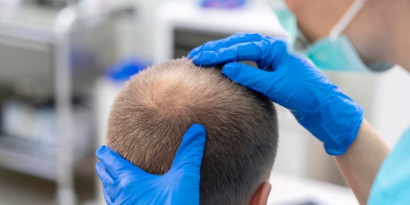 What is Hair Density? How to Measure and Increase Hair Density?