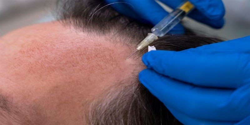 Does Anesthesia Cause Hair Loss