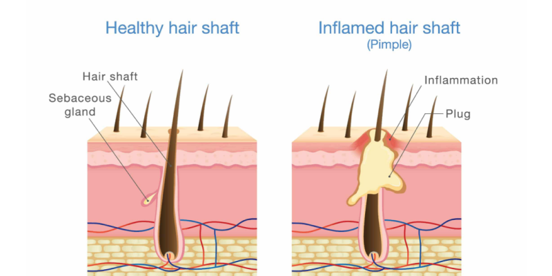 HAIROCRAFT's custom made... - Hair O Craft Hair Transplant | Facebook