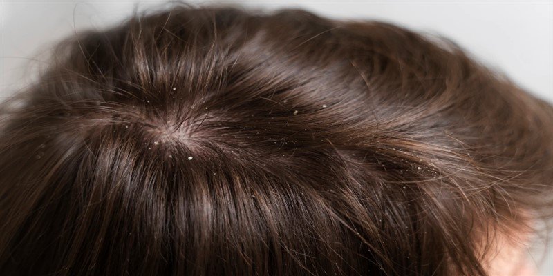 Does Dandruff Cause Hair Loss?