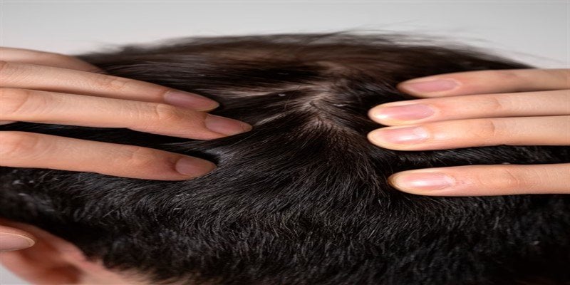Can Anemia Cause Hair Loss