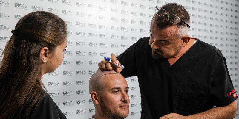 Hairline Lowering Surgery