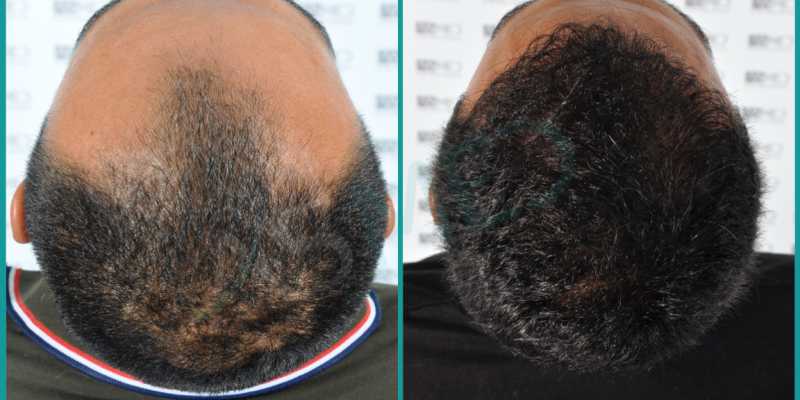 FUE Hair Transplant Before and After