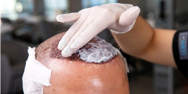 Do Hair Transplants Look Natural?
