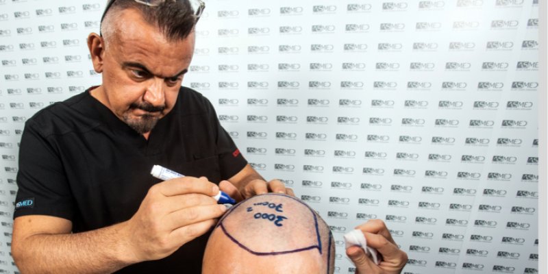 How to Fix A Receding Hairline