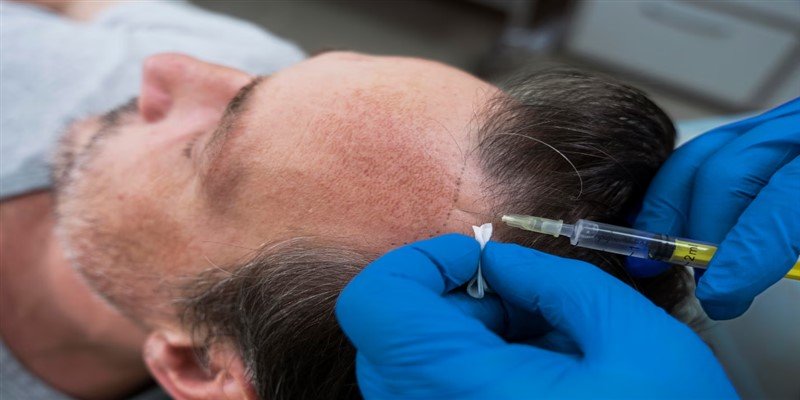Microneedling for Hair Loss